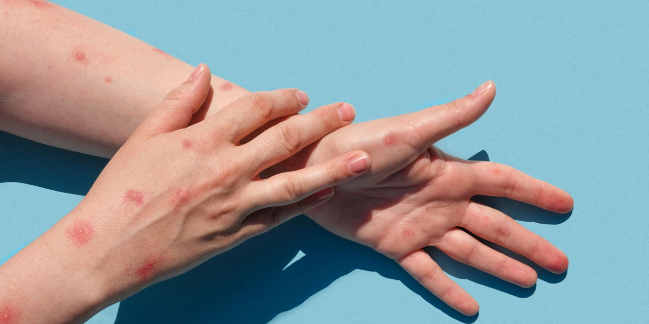 Sağlık Bakanı'ndan 'Maymun Çiçeği' açıklaması: Paniğe gerek yok, salgına dönüşmez