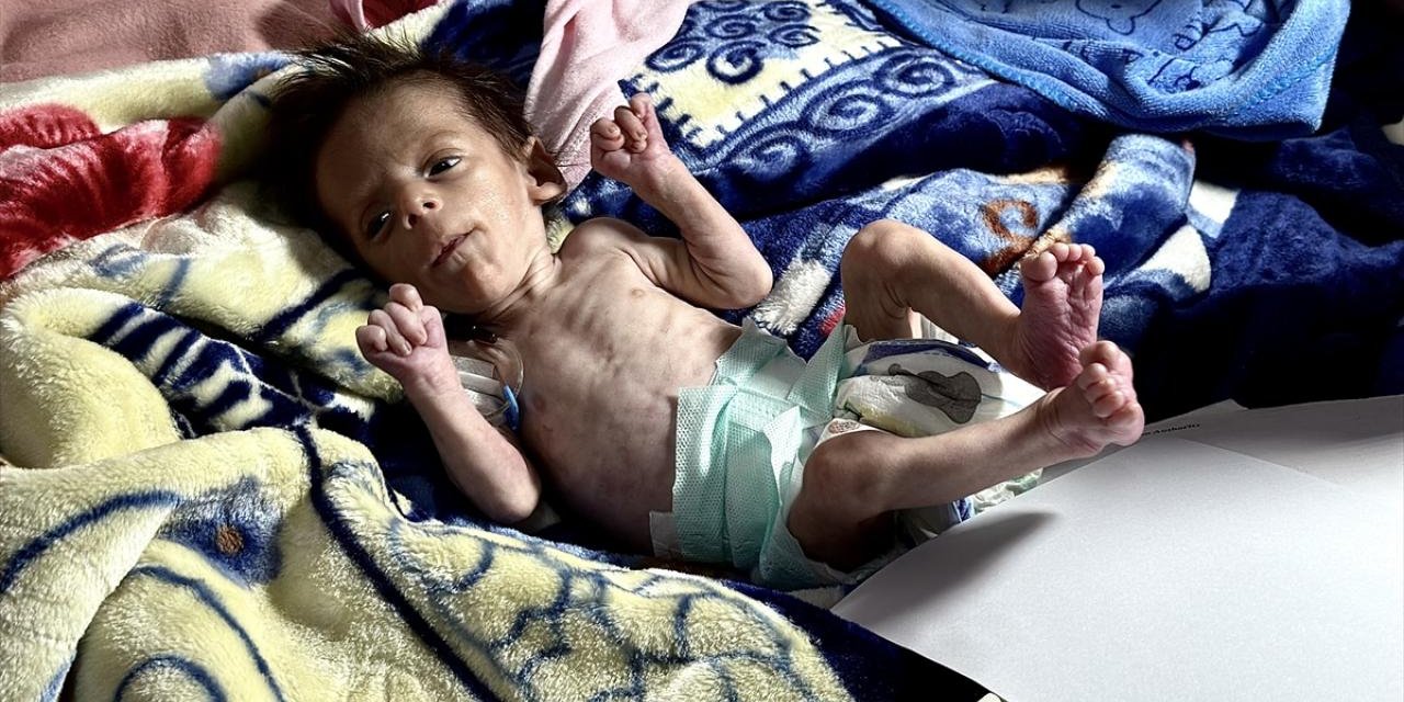 Gazze'de 4 aylık bebek yetersiz beslenmeyle bu hale geldi