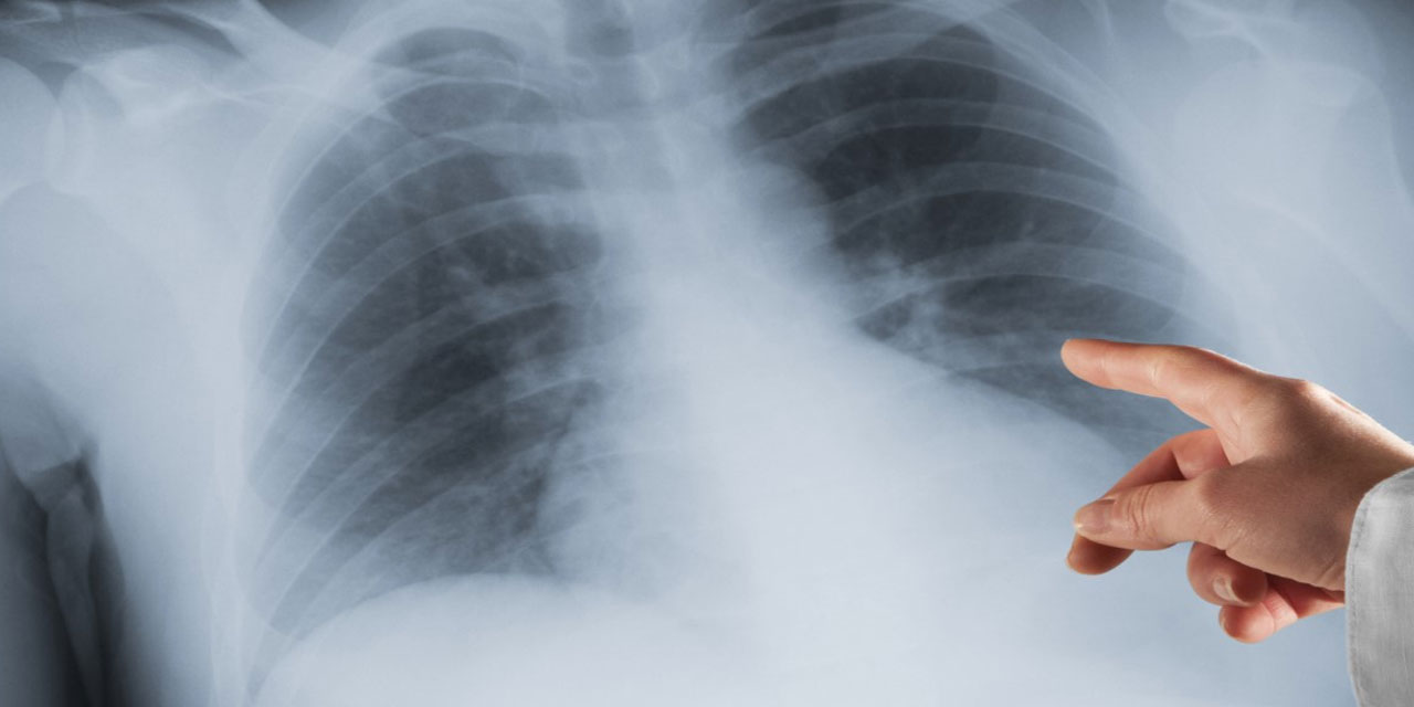 Sigara içenler yüzünden, içmeyenler de akciğer kanserine yakalanıyor