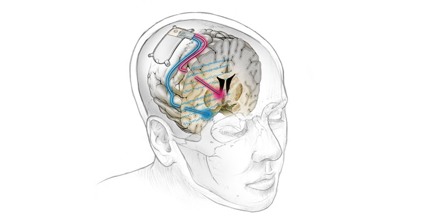 Kronik depresyon beyin implantıyla tedavi edildi